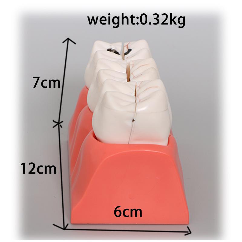 Прозора Знімна Повна Модель Щелепи з М'якими Яснами та Зубами для Підготовки до Імплантації
