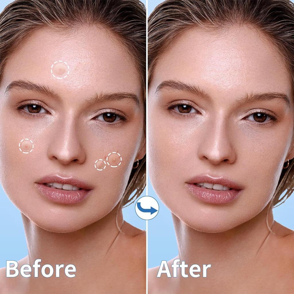 Acne Patch Large Capacity Pimple Patches, Cute Zit Covers,Hydrocolloid Acne Patches With Hyaluronic Sour 240pc