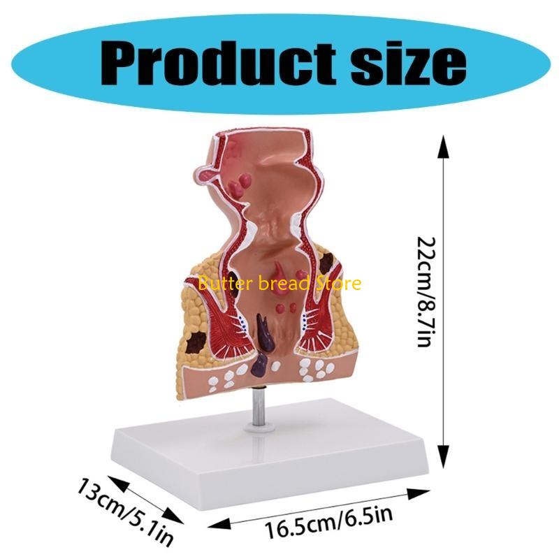 W89C Human Pathologies of Rectum Model Medicals Teaching Tool Human Rectum Model Human Anatomy Model Teaching Supplies