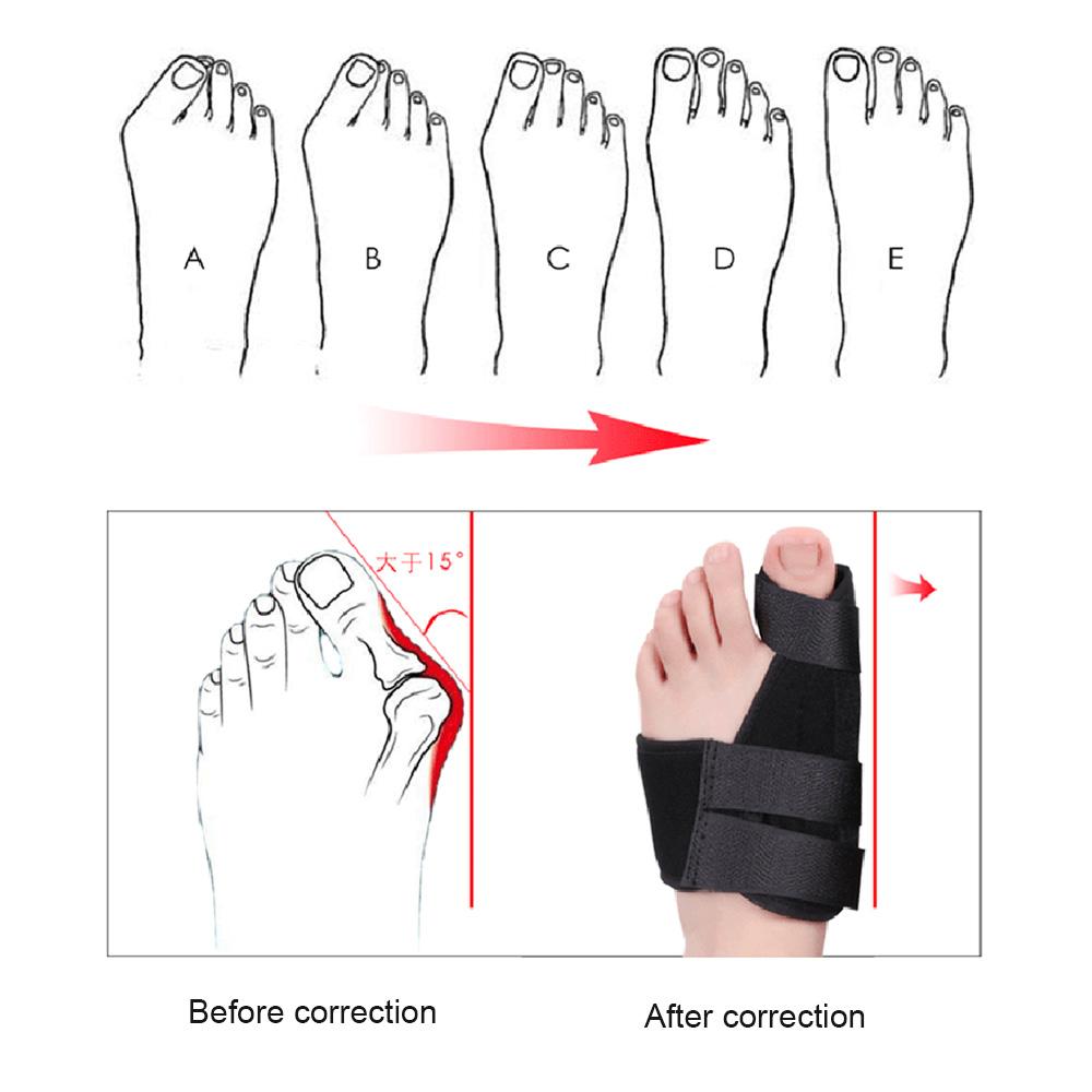 Toe Corrector Orthotics Bone Thumb Adjuster Hammer Protector Hallux Valgus Corrector Bunion Corrector Orthopedic Tool Care Tool