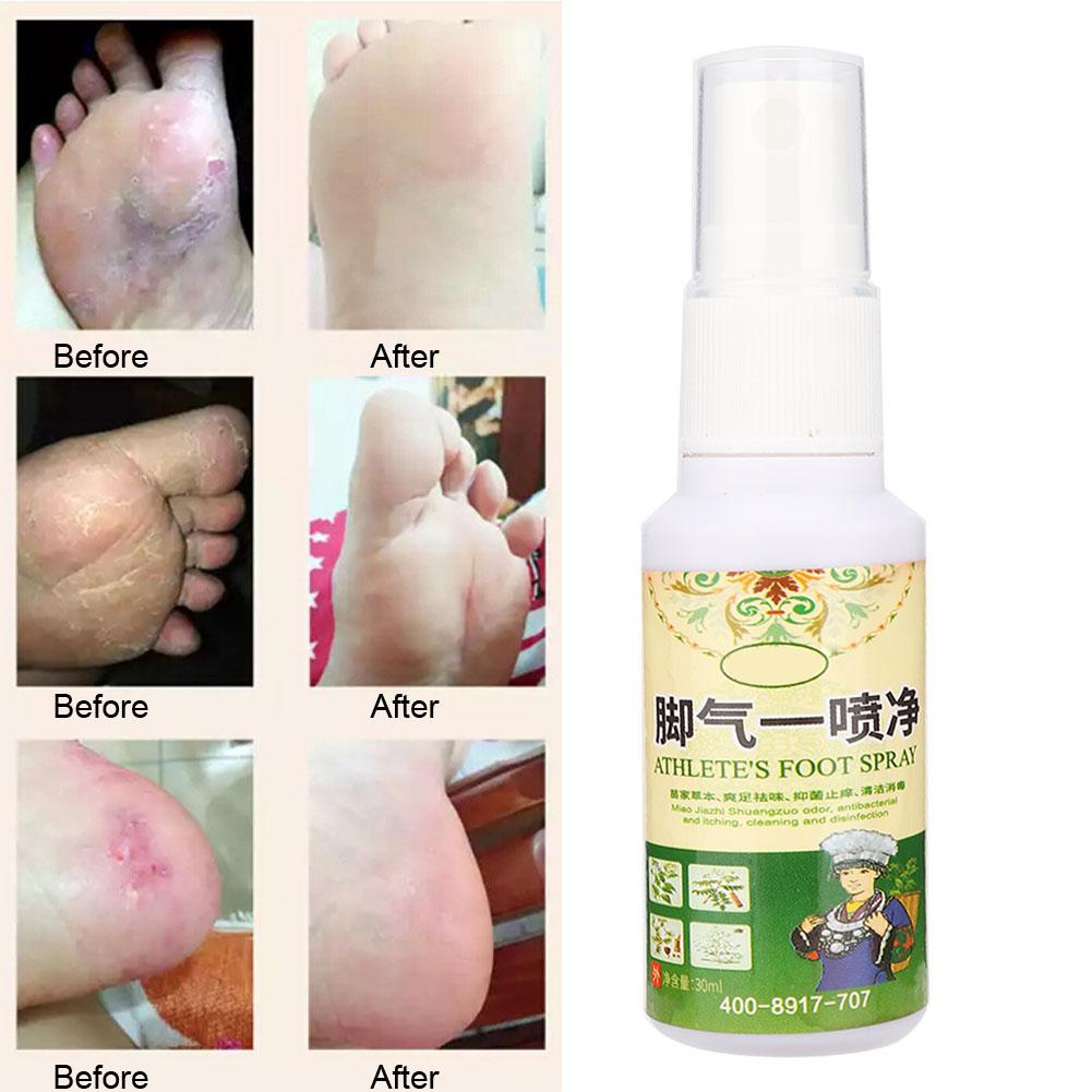 30ml Beriberi Removal Remove Foot Odor Sweat Antibacterial Bacteriostatic Plant Herb Spray