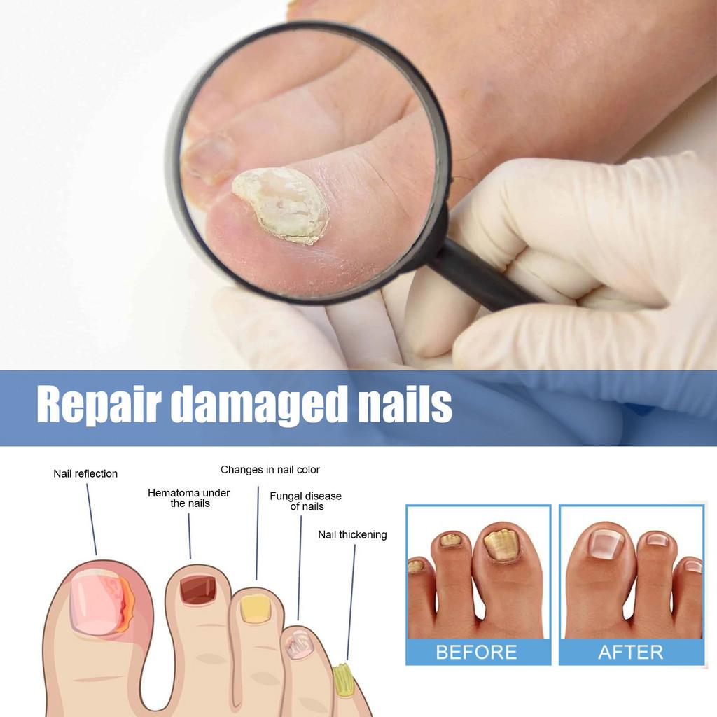 Ximonth Nighttime Nail Care Patches For Strengthening And Healing Weak Nails