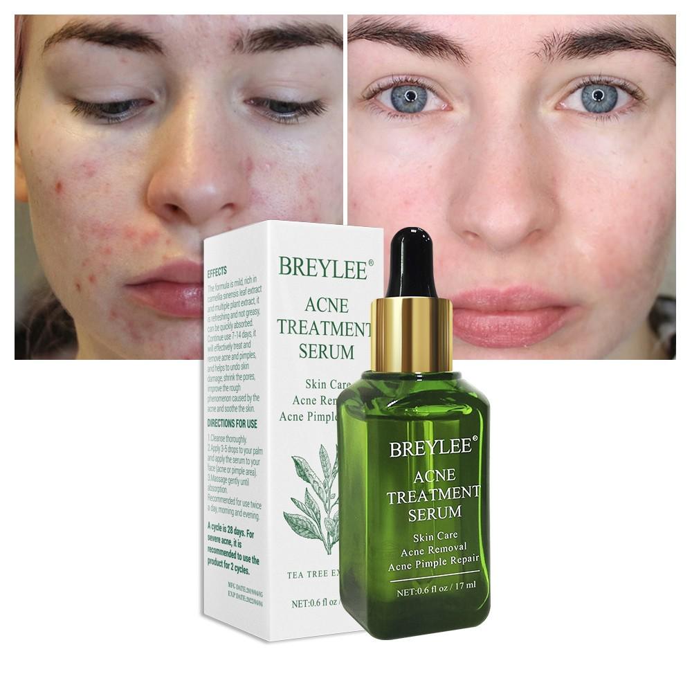 breylee acne serum