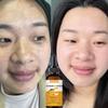 Brighten Face Essence, Remove Chloasma, Acne, Pigment, Black Spot, Pigmentation Skin Care Products