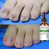 7DAYS Repair Nail Fungus Treatments Essence Foot Care Serum Toe Nails Fungal Removal Gel Anti-Infection