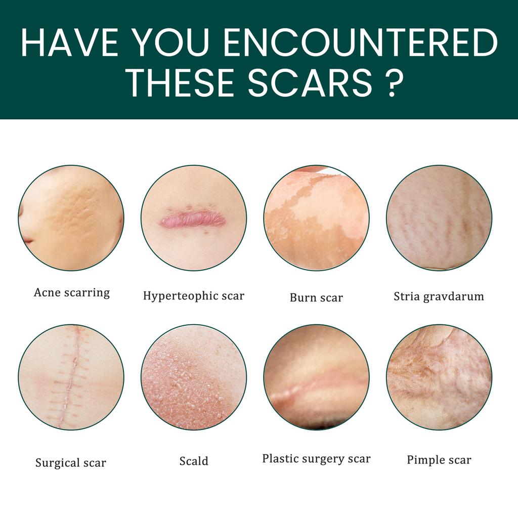 EELHOE 1 Roll Silicone Scar Removal Sheets for C-Section Postoperative Skin Colored Invisible Beauty Tape