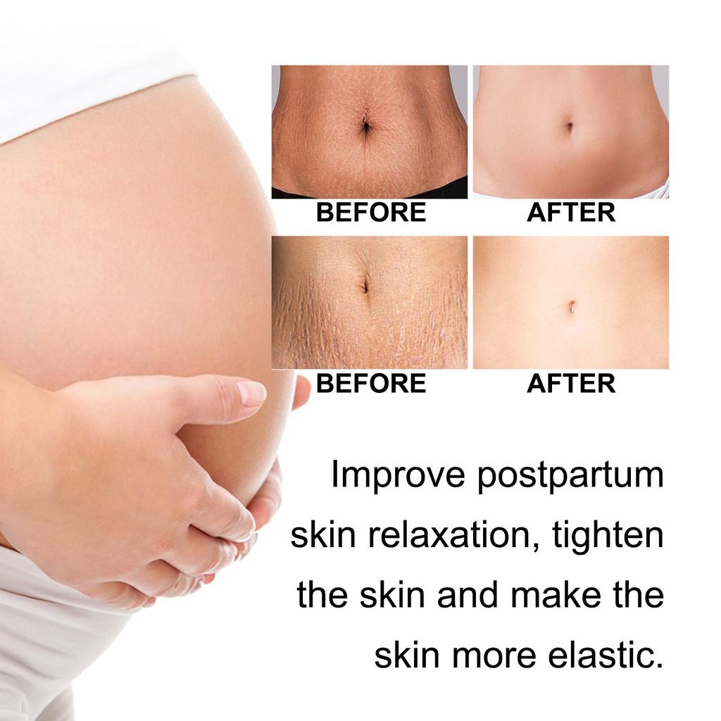 Ouhoe Pregnant Care Cream For Nourishing And Repairing Postpartum Skin Texture And Firmness