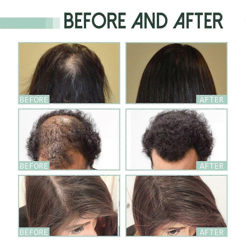 Revitalize Hair Growth Serum with Ginger & Plant Extracts Nourishing Scalp Treatment for Thicker, Stronger Hair, Reduces Hair Loss & Promotes Natural