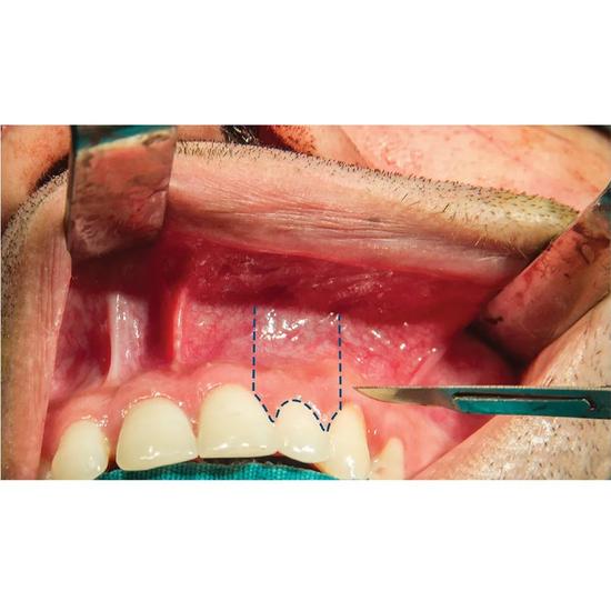 GDC Scalpel Handles (Bp Handle)