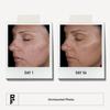Rodan + Fields Unblemish 30 Day Regimen For Adult Acne