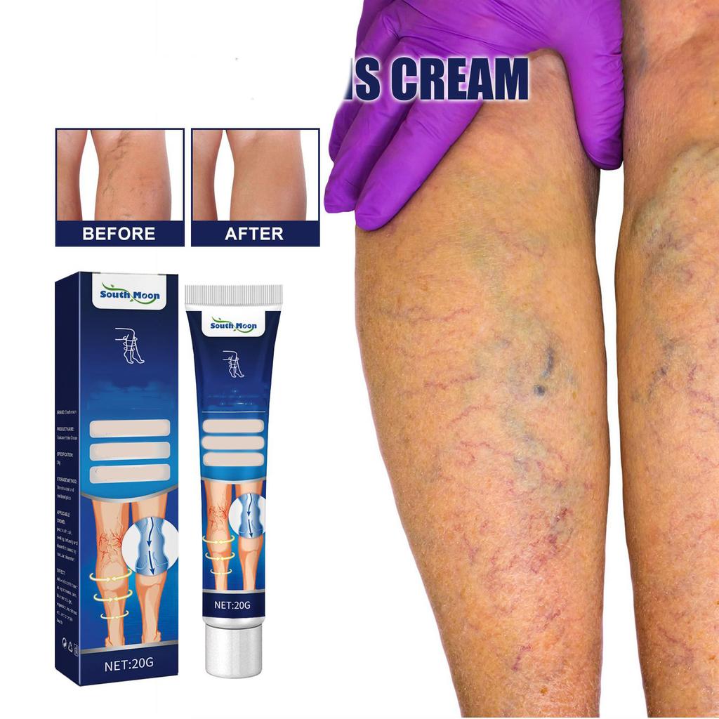 Pâte pour soulager les veines Venoheal, pâte pour les veines et les varicosités pour les jambes, améliore la circulation sanguine