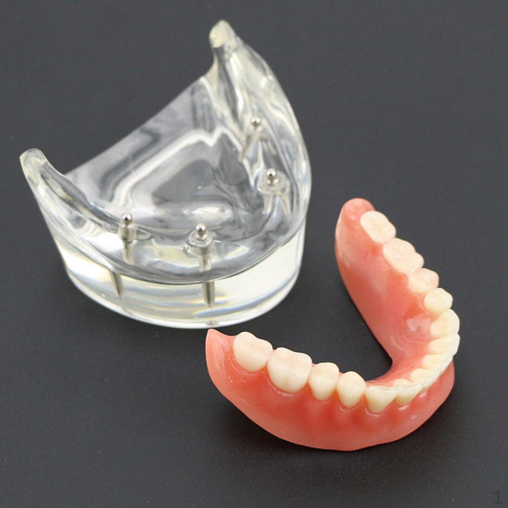 Teeth Implant Model Study Teaching with 4