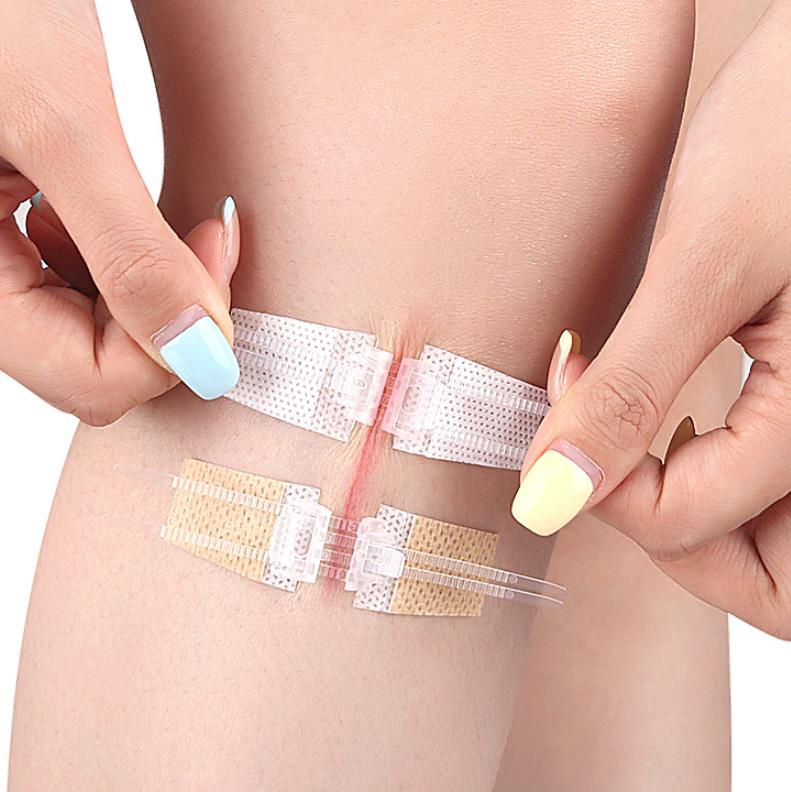 Reißverschluss-Krawatte Wundverschluss-Pflaster Hämostatisches Pflaster Wunde Schnell Ohne Naht Reißverschluss Outdoor-Pflaster Tragbar Schnell Gerinnendes Wund