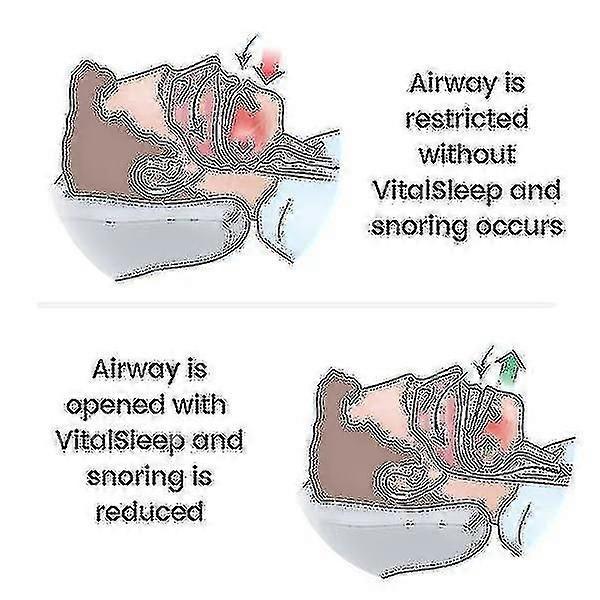 Adjustable Mouth with Silicone Anti-Snoring Device