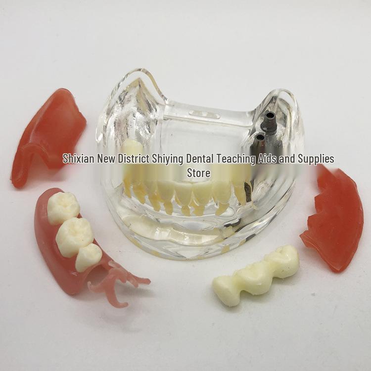 3-Screw Mandible Implant Model for Teaching Oral Cavity Restoration 6006