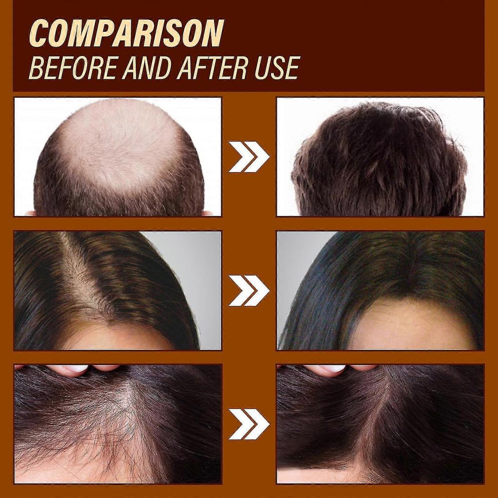 OUHOE Ginger Hair Growth Essence 6ml, Universal Hair Treatment, Moisturizing & Repairing, Strengthens Hair Roots, Anti-Hair Loss