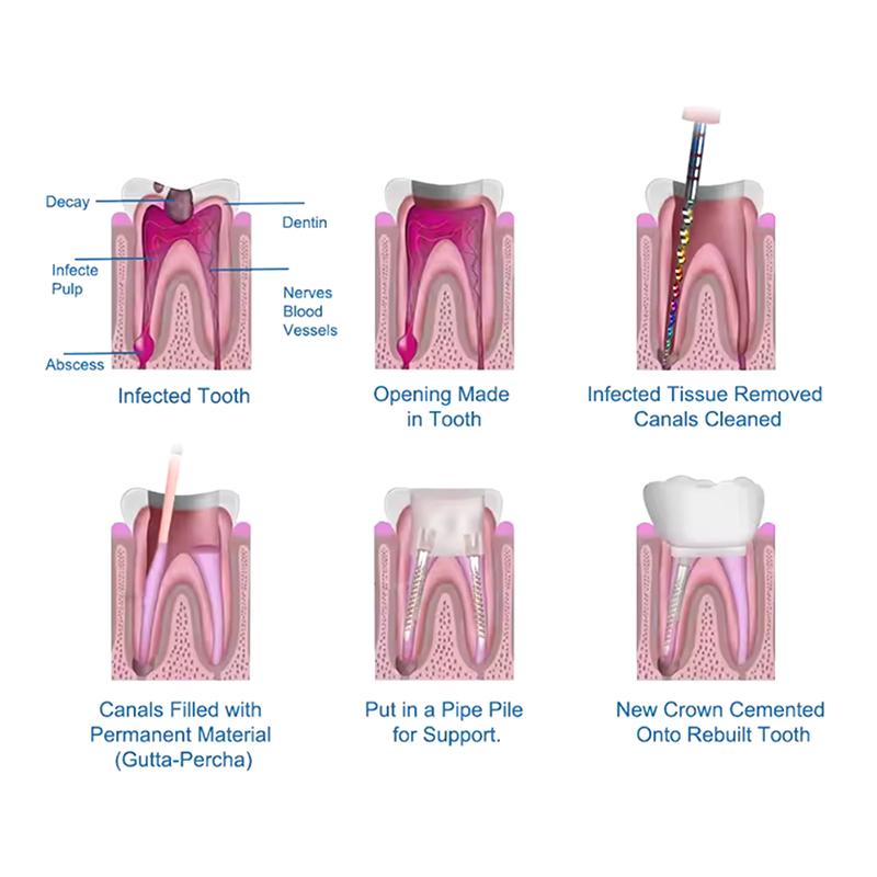 120 ks Zubní šroubové čepy Čistý titan Pozlacená úprava Implantátový jádro Kuželový šroubový čep S/M/L Závitový hřebík Fixace zubů