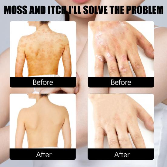 30ml Eczema Essence Non-Pungent Anti-Itch Herbal Extract Skin Salve Eczema Treatment Non Greasy Spray for Adult