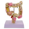 Menschliches Dickdarmmodell für Anatomie, Medizin, Lehrmodell, Pathologien des Dickdarmmodells für Studium und Ausstellung