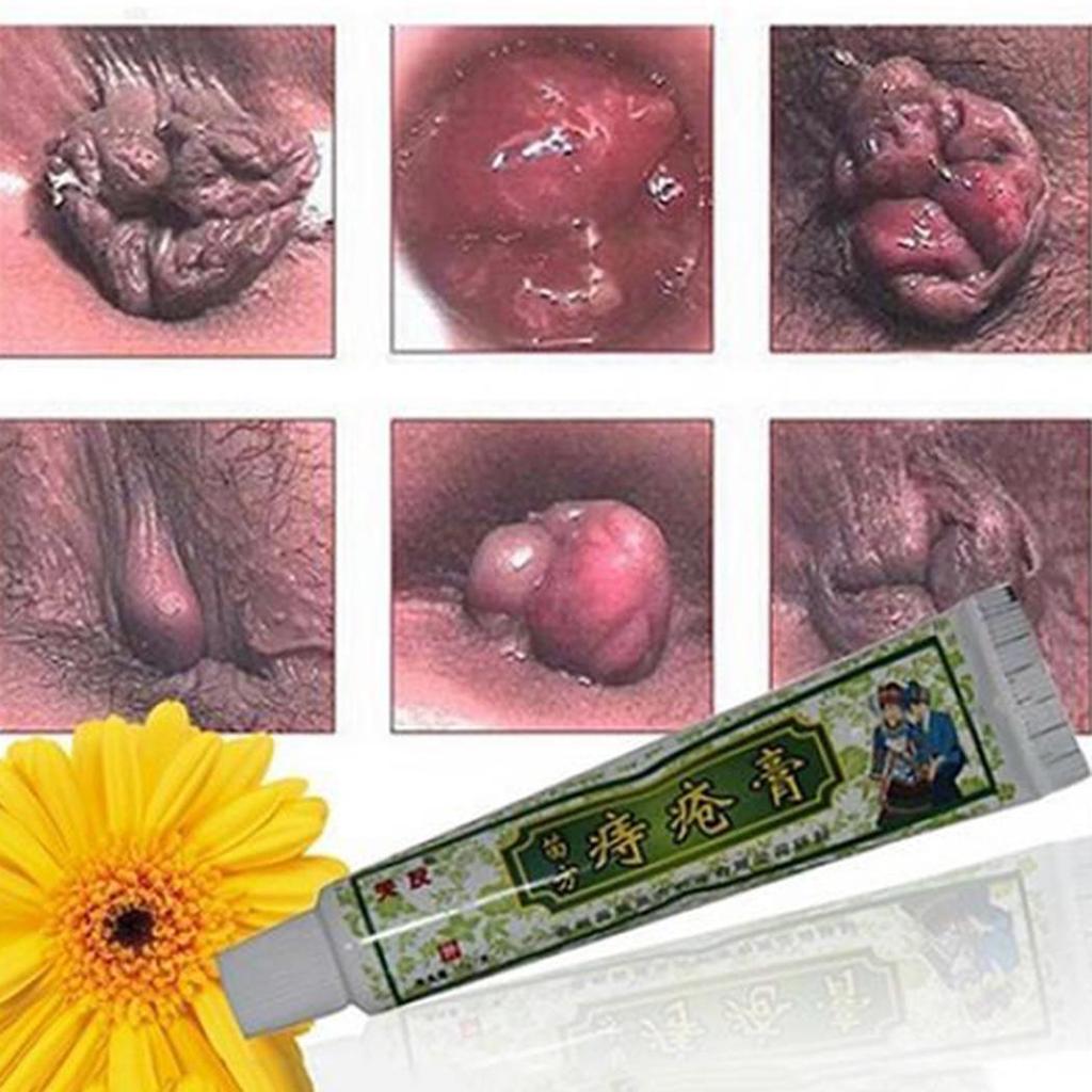 Krém na zevní léčbu KpacoTa Hemeroidy Mast se 3 tubami