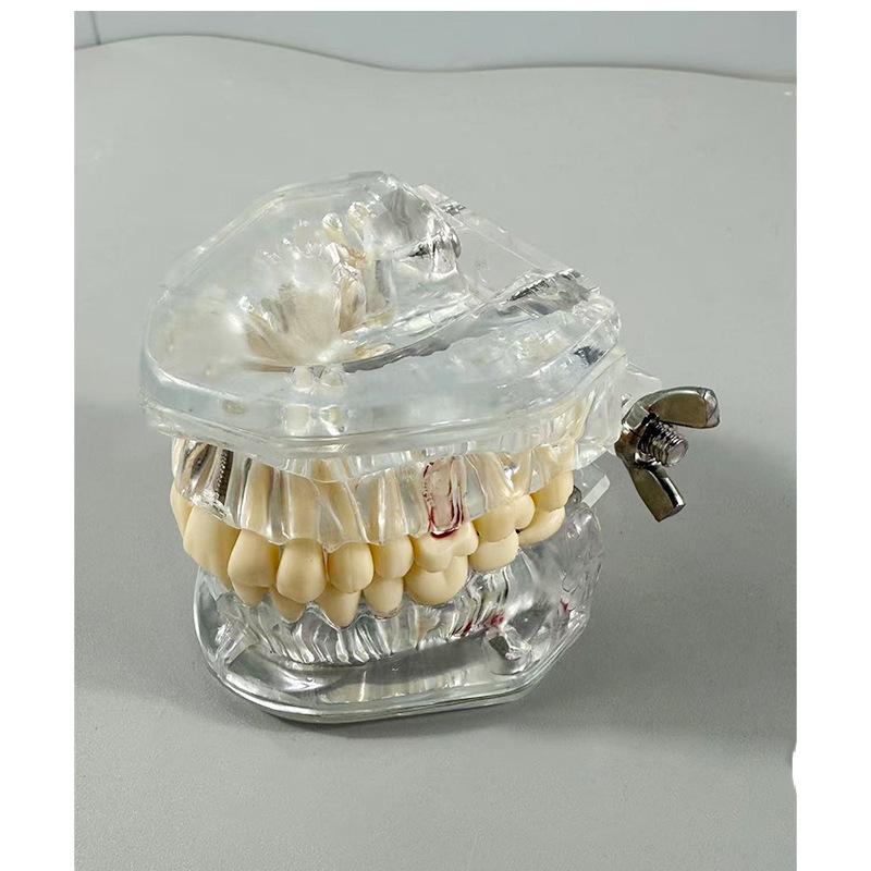 Прозора Знімна Повна Модель Щелепи з М'якими Яснами та Зубами для Підготовки до Імплантації