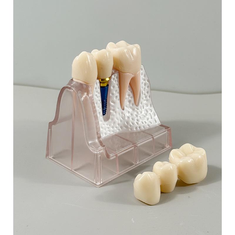 Прозора Знімна Повна Модель Щелепи з М'якими Яснами та Зубами для Підготовки до Імплантації