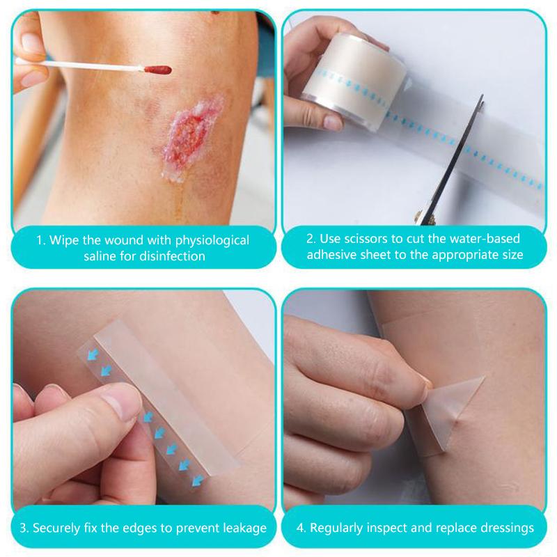 1 Rolle Hydrokolloid-Pflasterverbände für effektive Wundversorgung Extra dünn Weich Wasserdicht Selbstklebend Narbenabdeckungstape