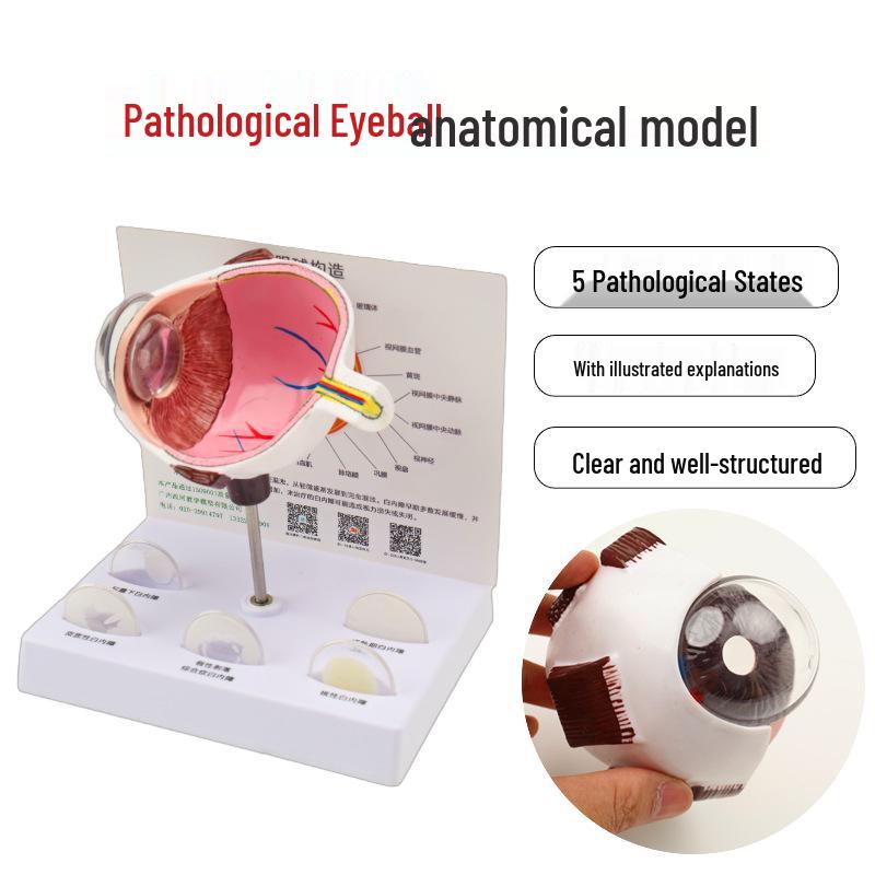 Ophthalmologist s Eye Lesion & Glaucoma Model for Patient Education