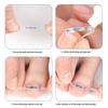 Double-Wing NiTi Alloy Bionic Bone Patch for Ingrown Toenail Correction (Invisible Physical Assistance Device).