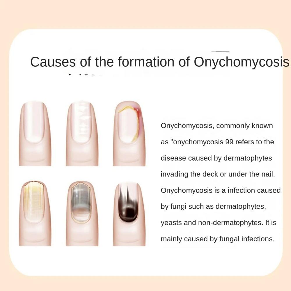 Praktische UV-Lampe zur Entfernung von Nagelpilz, Effektives Nagelpilz-Lasergerät, Heimgebrauch