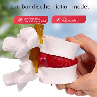 Genuine Lumbar Spine Protrusion & Vertebra Pathology Model