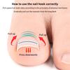 2Pcs Nail Correction Stickers Ingrown Toenail Corrector Patches Paronychia Treatment Recover Corrector Pedicure Tools Foot Care