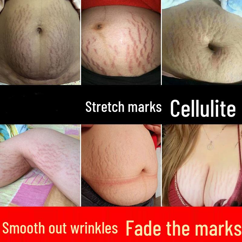 Postpartum Recovery Cream for Stretch Mark and Growth Mark Care Regular