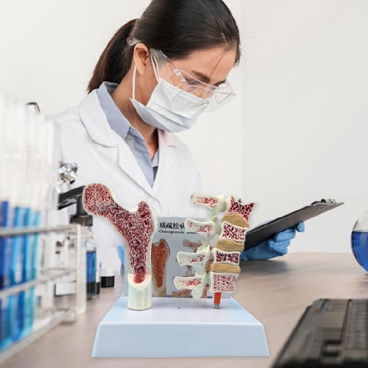 Menschliche Anatomie Osteoporose Modell Wirbel Anatomisches Skelettmodell für Medizinstudenten Lehrdemonstration