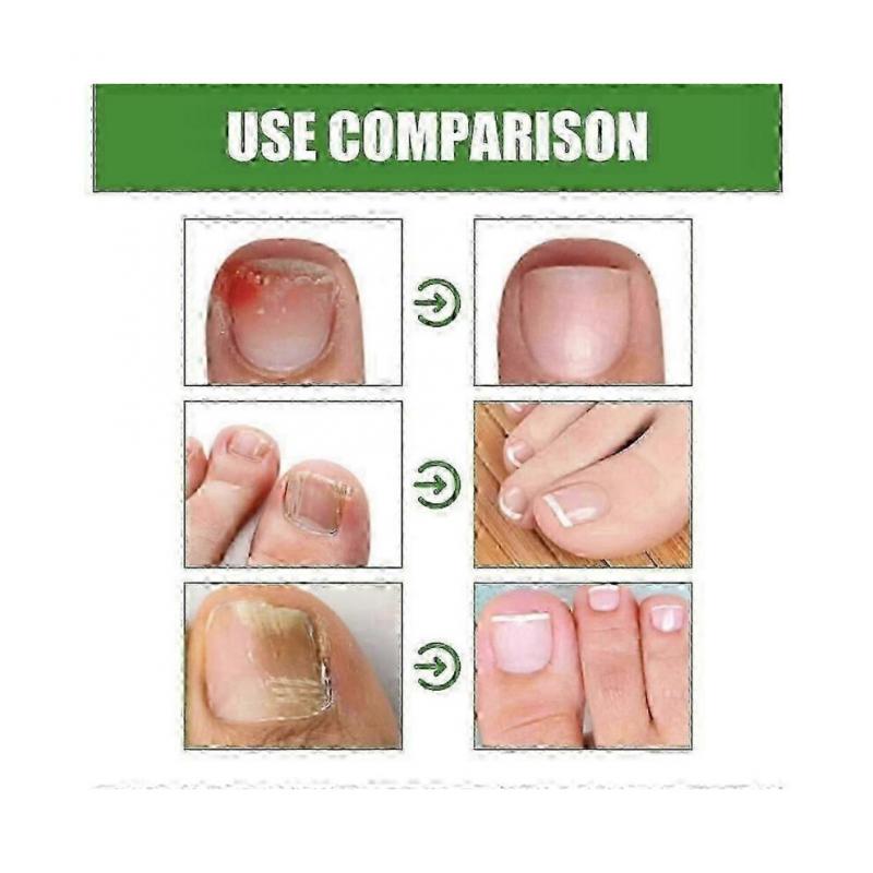 1-3X Nagelschutz ANTI-PILZ STIFT Nailshield Anti-Pilz Stift,Monsalife Nagelschutz Anti-Pilz Stift