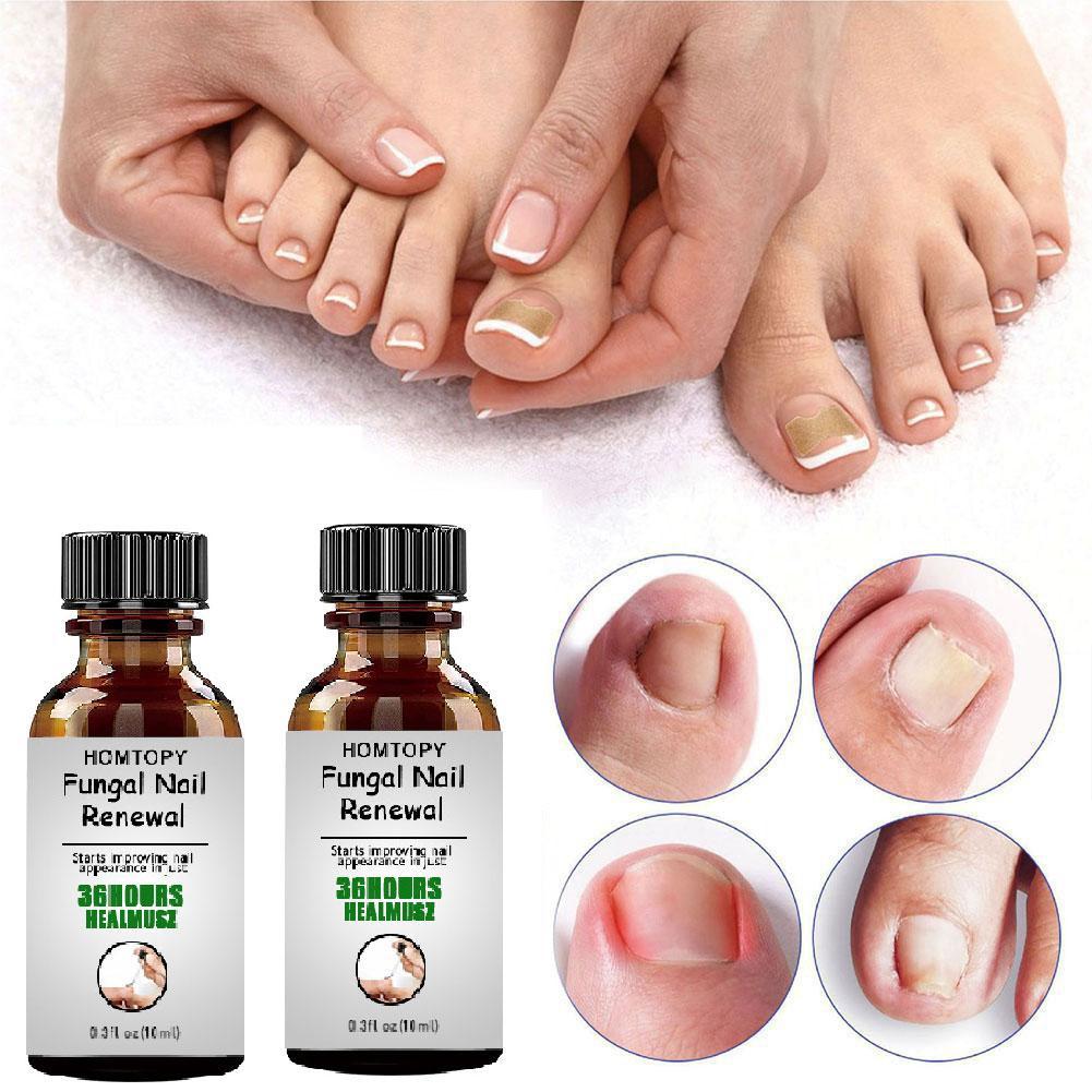 10ML Toenail Nail Fungus Treatment Repair Fingernail Device Foot Toenail Fungus Essential Care F0N3