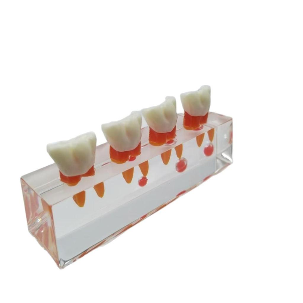 PH4018 Detachable Doctor-Patient Pulp Restoration Pathology Teaching Model