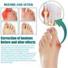 6 Stücke Gicht Behandlung Patch Finger Bunion Pain Relief Gips Fuß Daumen Korrektor