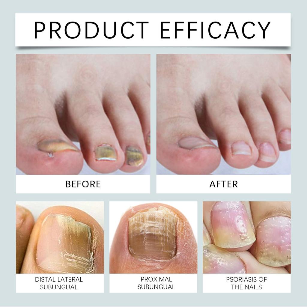 Ouhoe Nagel-Erleichterungsspray für gesunde Nagelhaut und verdickte Nagelpflege 30ml