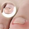 Verktyg för korrigering av inåtväxt tånagel Elastisk tånagelsrätare Silikon tånagelskorrektorer