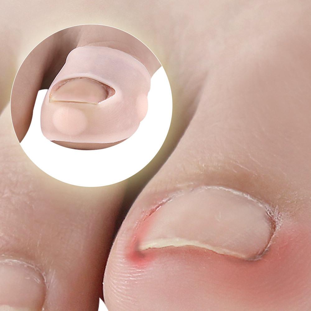Verktyg för korrigering av inåtväxt tånagel Elastisk tånagelsrätare Silikon tånagelskorrektorer