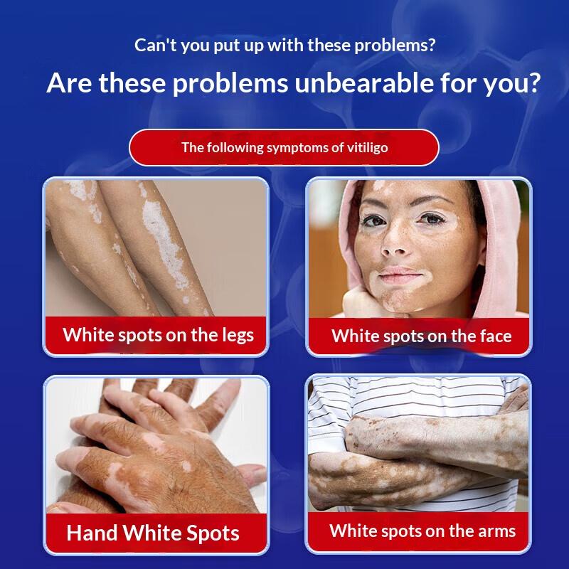 Cream for Uneven Skin Tone: Works To Restore Skin Affected by Vitiligo