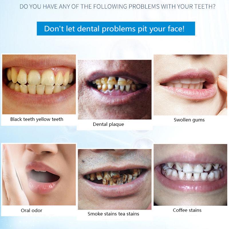 coffee and cigarette stains on teeth Cleaning Smoker's with Heavy Stain Can Teeth Whitening Remove Coffee,