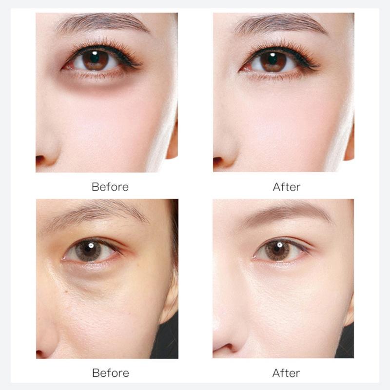 under eye whitening