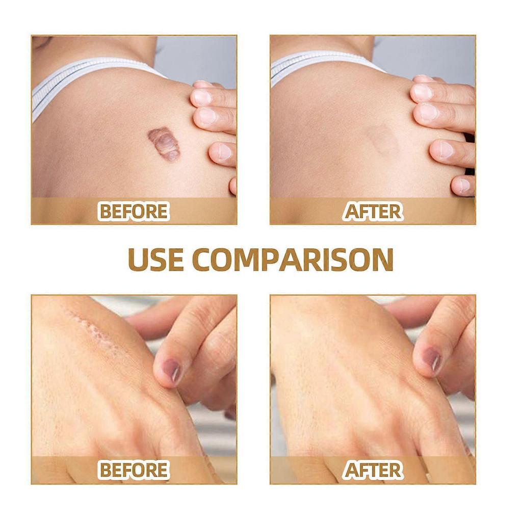 Skin Invisible Concealer Patch Skin Scar Tattoo Acne Mark Cover Patch Waterproof Skin Color Invisible Patch 60pcs
