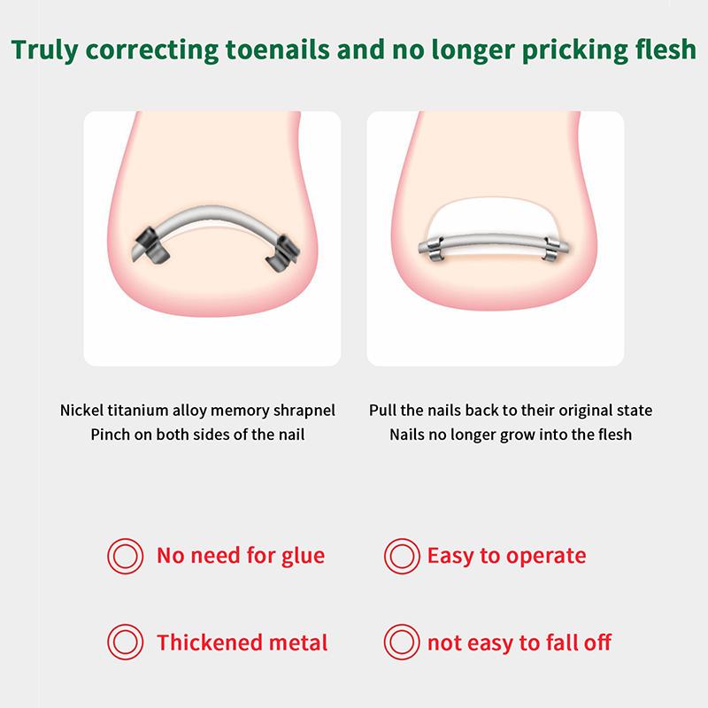 Toe Ingrown Pedicure Nail Buckle Toenails Corrector Foot Nail Correction Tool Straightening Clip Curved Brace Corrector