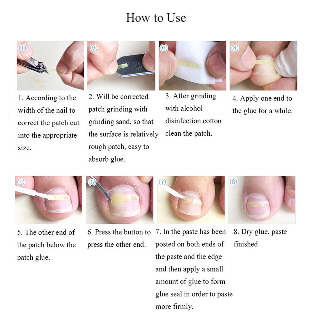 Ingrown Toenail Correction Set Toenail Treatment Toenail Straightening Patch Lifter Fixer Recover Tool Foot Care Kit