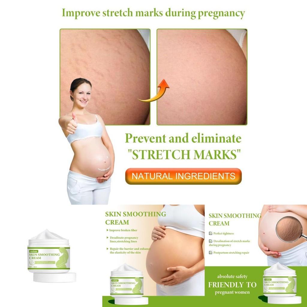 Ouhoe Skin Smoothing Cream Moisturizing Formula For Scar Reduction And Stretch Marks