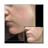 Adjustable Microneedle Derma Stamp for Face Skin Acne Scar Repair And Hair Growth - Microneedling Derma Roller Pen Tool