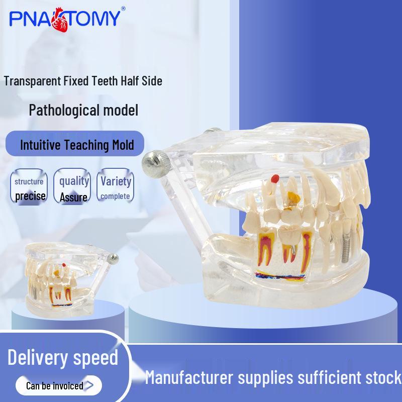 Transparent Detachable Half-Side Pathological Tooth Model for Implant Restoration 9.5*7*6 cm